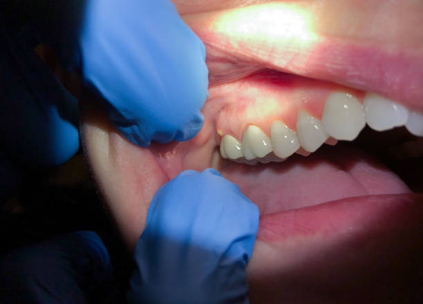 Best Emergency Tooth Extraction in Naval Academy, MD